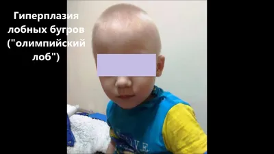 Рахит — симптомы, лечение, профилактика рахита у детей