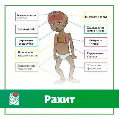 Рахит. Причины и профилактика. Базовые понятия - добрый доктор