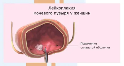 Удаление полипа уретры | Клиника «АльтраВита» | Дзен