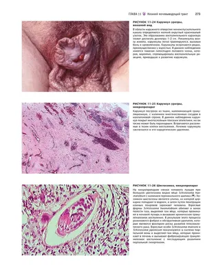 Полипы в мочевом пузыре у мужчин и женщин: симптомы, лечение, удаление