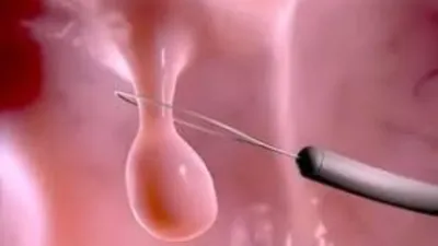 Удаление полипа уретры | Клиника «АльтраВита» | Дзен