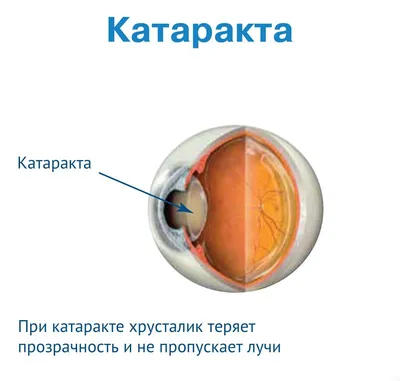 Операция по удалению катаракты | Цены на лечение в Москве