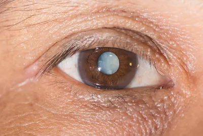 Початкова катаракта — що це, причини, симптоми та лікування | Блог | GlazGo