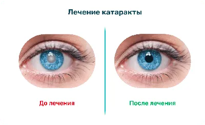 Возрастная катаракта - лечение в клинике им. С. Фёдорова г. Москва