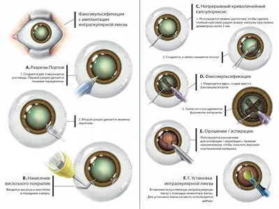 Лечение катаракты в Санкт-Петербурге - цена операции в клинике «Счастливый  Взгляд»