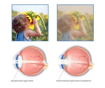 Замена помутневшего хрусталика глаза (катаракта) при кератоконусе