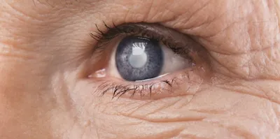 Хирургия катаракты — Ovisus