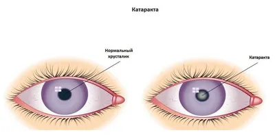 Профилактика катаракты: что можно сделать для предотвращения болезни? |  Статьи «Омнифарм»