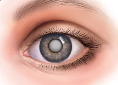 4 стадии катаракты ⬇️ Катаракта - это полное или частичное помутнение  хрусталика. Ткани глаза стареют, хрусталик теряет прозрачность и… |  Instagram