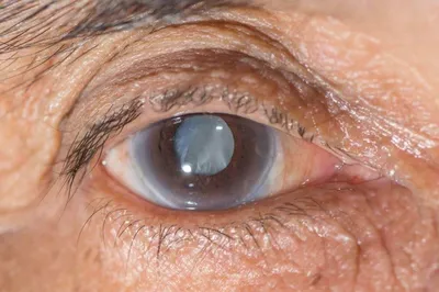 Катаракта (помутнение хрусталика глаза) - причины, симптомы, диагностика