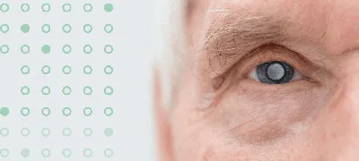 Возрастная катаракта — диагностика и лечение в Киеве | Visiobud