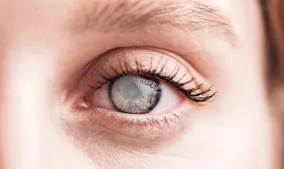 Чем опасна катаракта и как её лечить? | Центр зрения – сеть  офтальмологических клиник | Дзен
