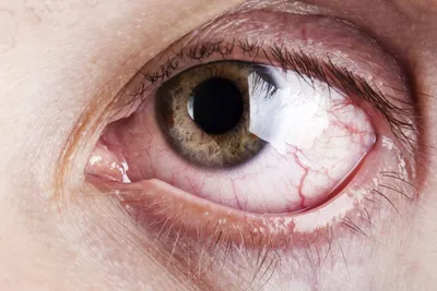 Перезрелая катаракта — что это, причины, симптомы и лечение | Блог | GlazGo