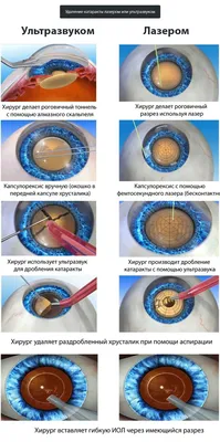 Глаукома и ее лечение с помощью различных методов - Офтальмологические  клиники «Эксимер» (Киев) – диагностика и лечение заболеваний глаз у  взрослых и детей Киев