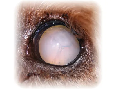 Замена помутневшего хрусталика глаза (катаракта) при кератоконусе