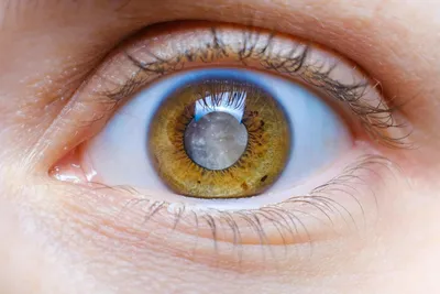 Возрастная катаракта: причины возникновения, стадии развития, эффективное  лечение - Офтальмологические клиники «Эксимер» (Киев) – диагностика и  лечение заболеваний глаз у взрослых и детей