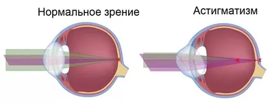 Возрастная катаракта: причины, симптомы и методы исправления