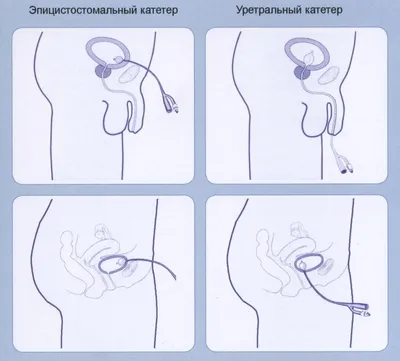 Мочевыводящая система и катетер | АО АКЦЕПТ