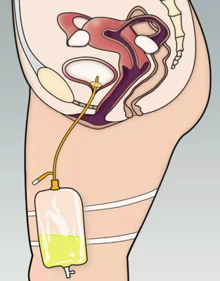 Катетеризация мочевого пузыря у женщин в Хабаровске - Медикъ