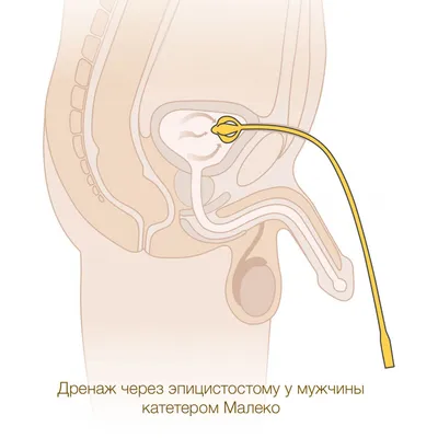 Катетеры Малеко MEDEREN – купить по выгодной цене на сайте oxy2.ru