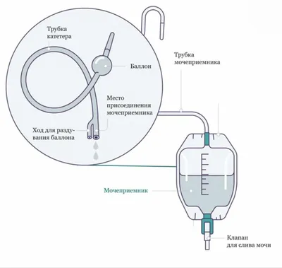 Катетер с силиконовым мешком для сбора мочи у пожилых и лежащих больных –  лучшие товары в онлайн-магазине Джум Гик