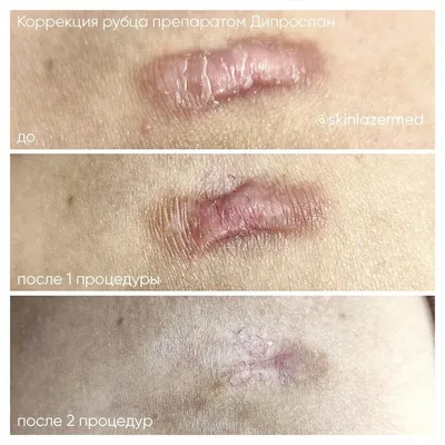 Лечение келоидных рубцов инъекции Дипроспан - SkinLazerMed
