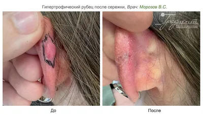 Хирургическое иссечение рубцов, коррекция, удаление келоидного рубца.  Операции по коррекции, удалению, иссечению рубцов хирургическим путем в VIP  Clinic