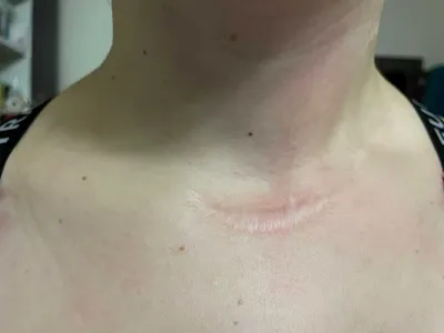 Келоидный рубец
