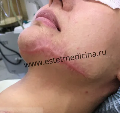 Что такое келоидные шрамы и что вы можете с ними сделать - Здоров'я - Статьи