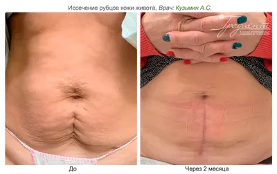 Келоидные рубцы: лечение, после, фото | Интернет-журнал Estetmedicina.ru