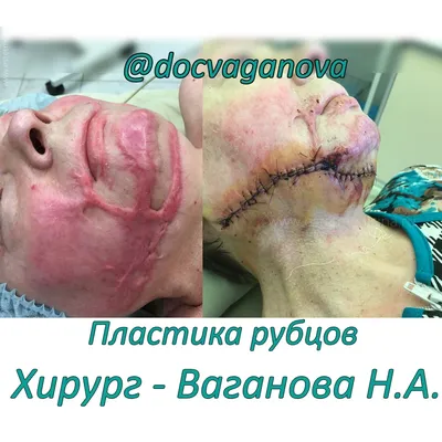 Удаление келоидных рубцов лазером в Санкт-Петербурге — БИОМЕД