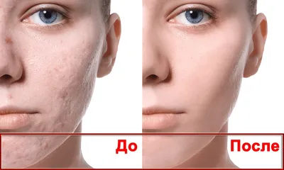 Лечение рубцов кожи после операции – лечение келлоидных рубцов в «Клинике  Хелена»
