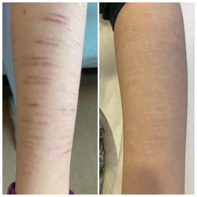 cleopatra_clinic_karaganda - Келоидные рубцы Келоидные рубцы — особый вид  рубцов, внедряющихся в окружающие нормальные ткани. ￼ ЧТО ТАКОЕ КЕЛОИДНЫЕ  РУБЦЫ? Рост келоидных рубцов обычно начинается через 13 месяцев после  заживления раны. К