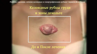 Коррекция келоидных, гиперторофированных рубцов - Пластический хирург  Константин Клименко
