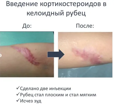 Удаление рубцов дипроспаном и кеналогом в СПб