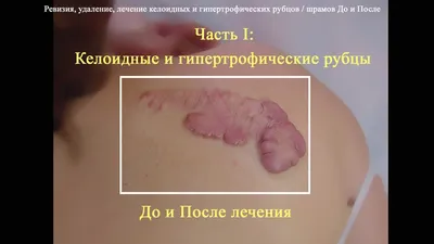 Рубцы. Разновидности и выбор способа лечения | Статьи