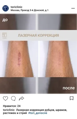 Удаление шрамов и рубцов | Damas Medical Center