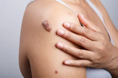 Рубцы постакне: лечение рубцов после акне - Premium Aesthetics