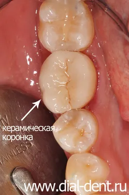 🦷 Керамические коронки E-max ☑ Стоматология в Киеве и Львове ☑ Giorno  Dentale