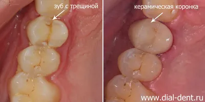 Керамические коронки - Стоматология \"Дантист\" в Воронеже