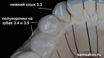 Виды зубных коронок: какие бывают, какие лучше, цены.
