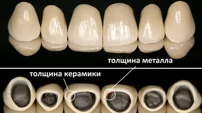 Керамические коронки: преимущества выбора