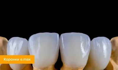 Керамические коронки на зубы дисиликат лития E.MAX