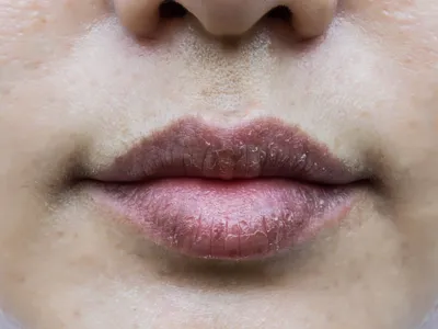 Как лечить хейлит на губах: что это такое