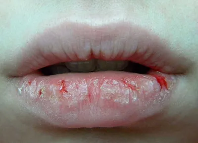 Аллергический хейлит на губах: лечение, симптомы