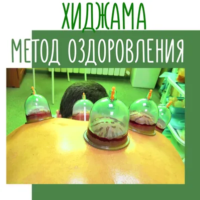 Хиджама - капиллярное кровопускание - «Чудо средство от многих болезней.  капилярное кровопускание - хиджама отзыв, эффект от процедуры. Все плюсы и  минусы процедуры, чего не стоит боятся .» | отзывы