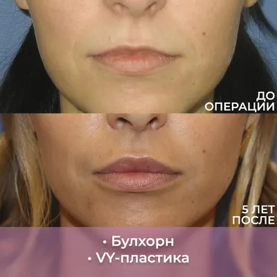 Увеличение губ без филлеров / Хейлопластика / VY-пластика | Абриелль | Дзен