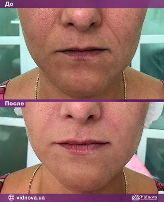 Dr. Ani Sargsyan - V-Y #пластика #губ – операция по изменению формы и  увеличению объема губ за счет перемещения части слизистой оболочки наружу.  К V-Y пластике прибегают 🔸️при асимметрии, 🔸️недостаточном объеме,  🔸️возрастных