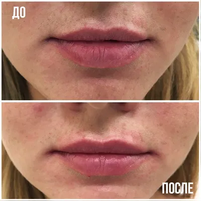 Lip Lift - операция по субназальному поднятию губы