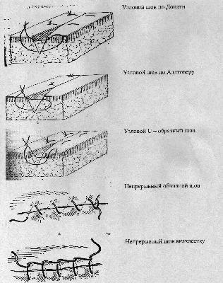 медицинские швы после операции швыряли хирургические швы на человеческом  теле Стоковое Изображение - изображение насчитывающей людск, струпь:  252818895